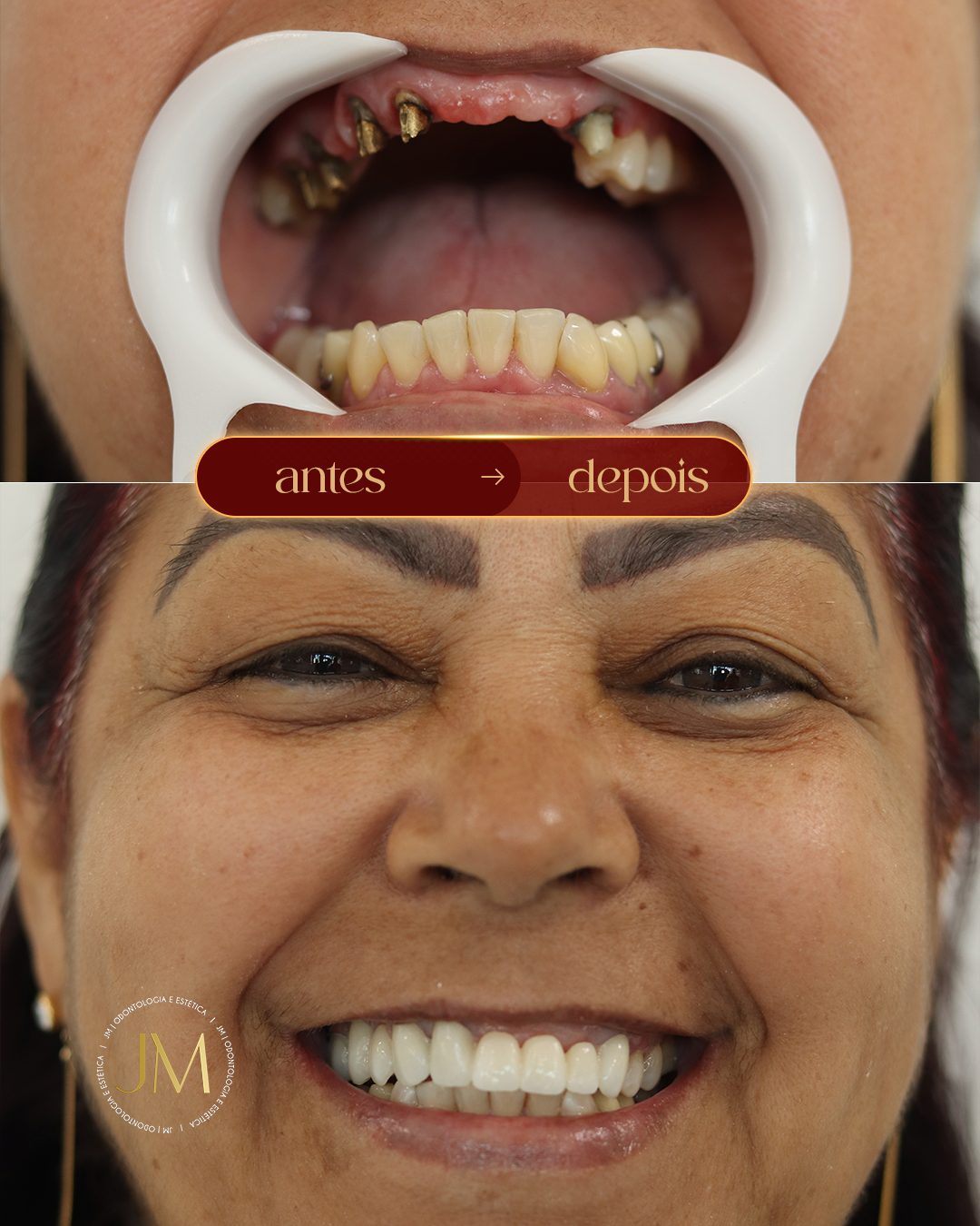 Antes e depois: reabilitação com implantes, JM Clinic