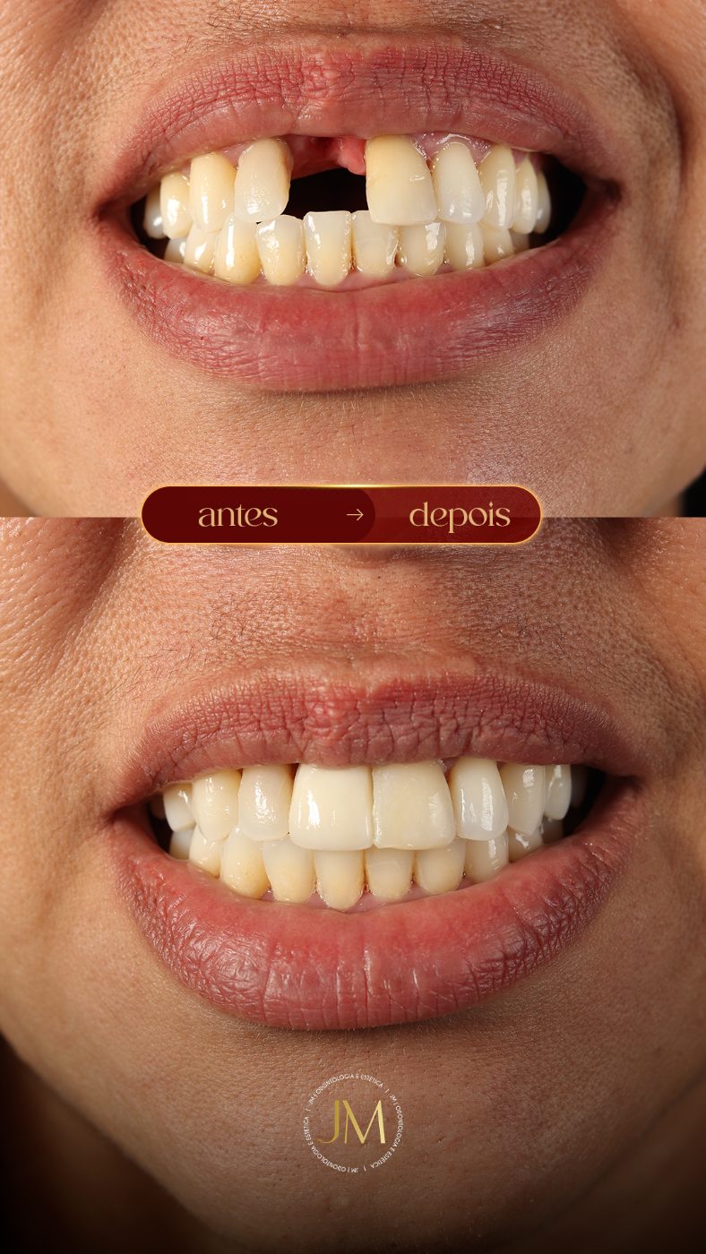 Antes e depois: prótese fixa sobre implantes, JM Clinic