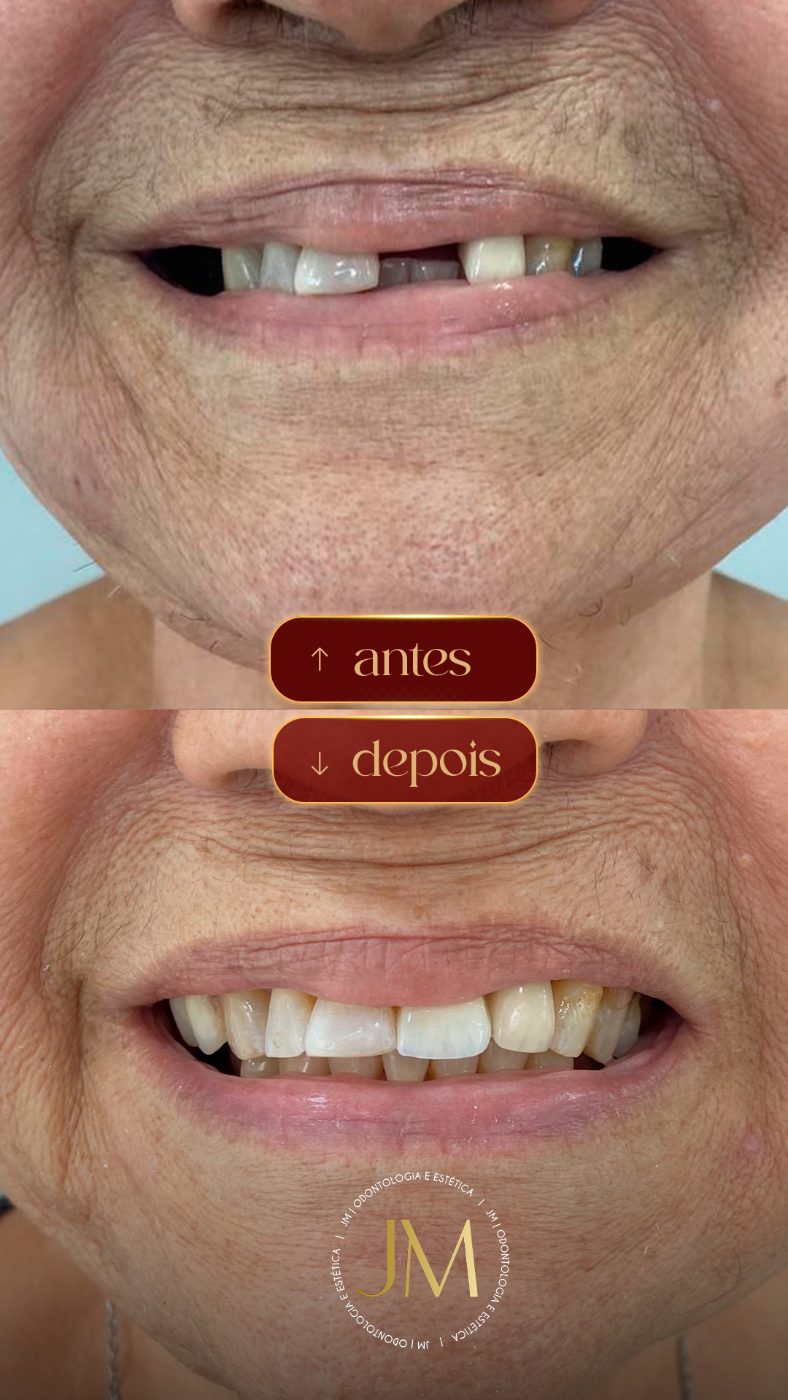 Antes e depois: implante unitário, JM Clinic