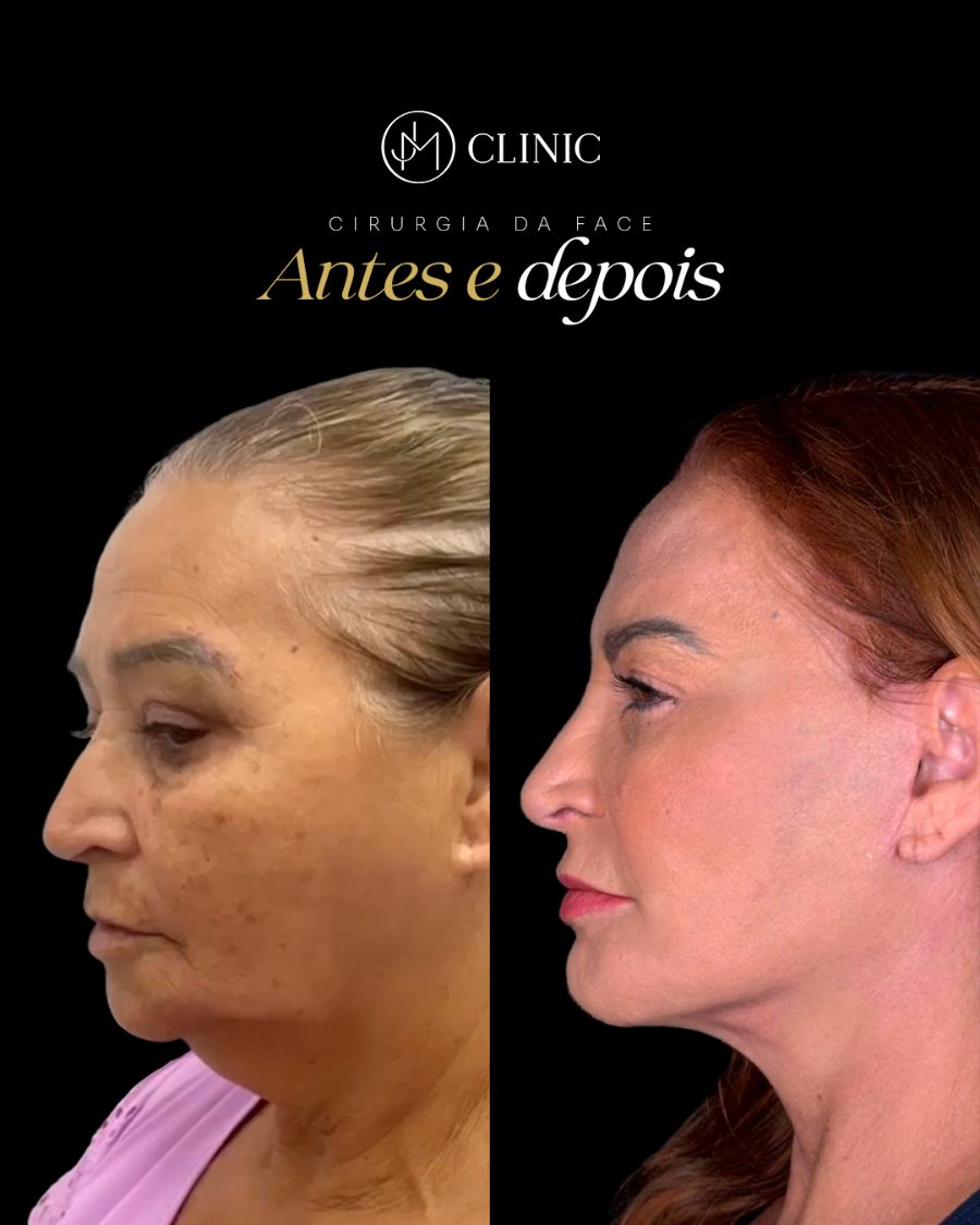 Antes e depois de blefaroplastia e cirurgia facial, caso acompanhado pela equipe