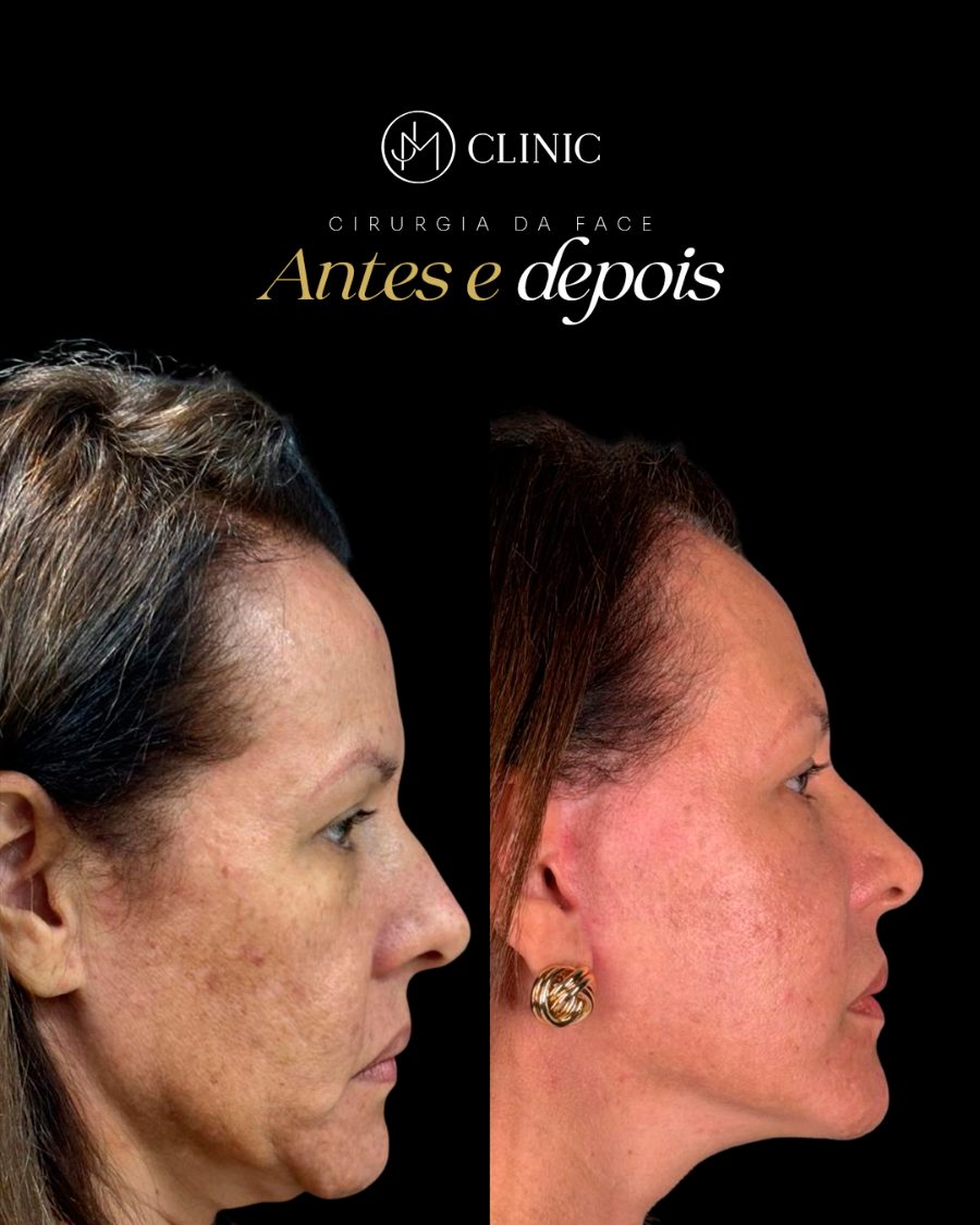 Antes e depois de contorno facial, caso avaliado individualmente