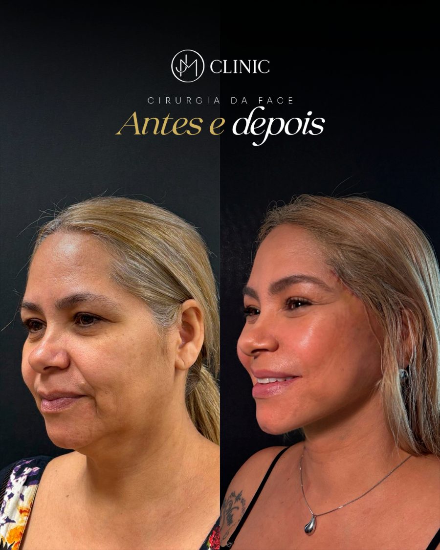 Antes e depois de procedimento facial, caso individual