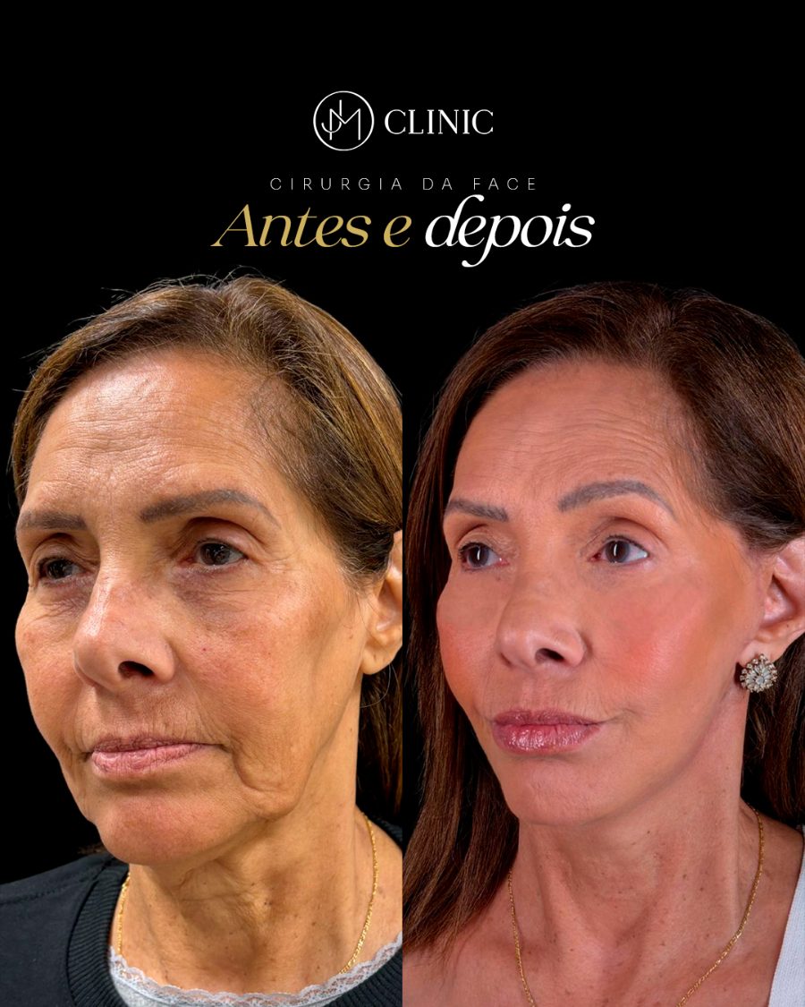 Antes e depois de cirurgia estética da face na JM Clinic, caso individual