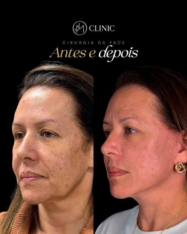 Caso real de cirurgia da face acompanhado pela JM Clinic, imagem 07