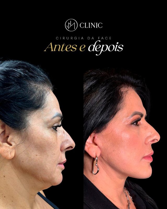 Caso real de cirurgia da face acompanhado pela JM Clinic, imagem 08